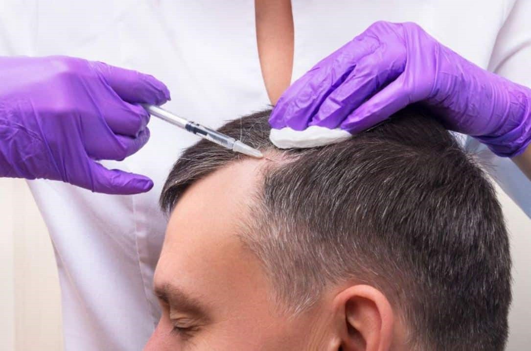 Best Hair Transplant Clinics for Natural Results