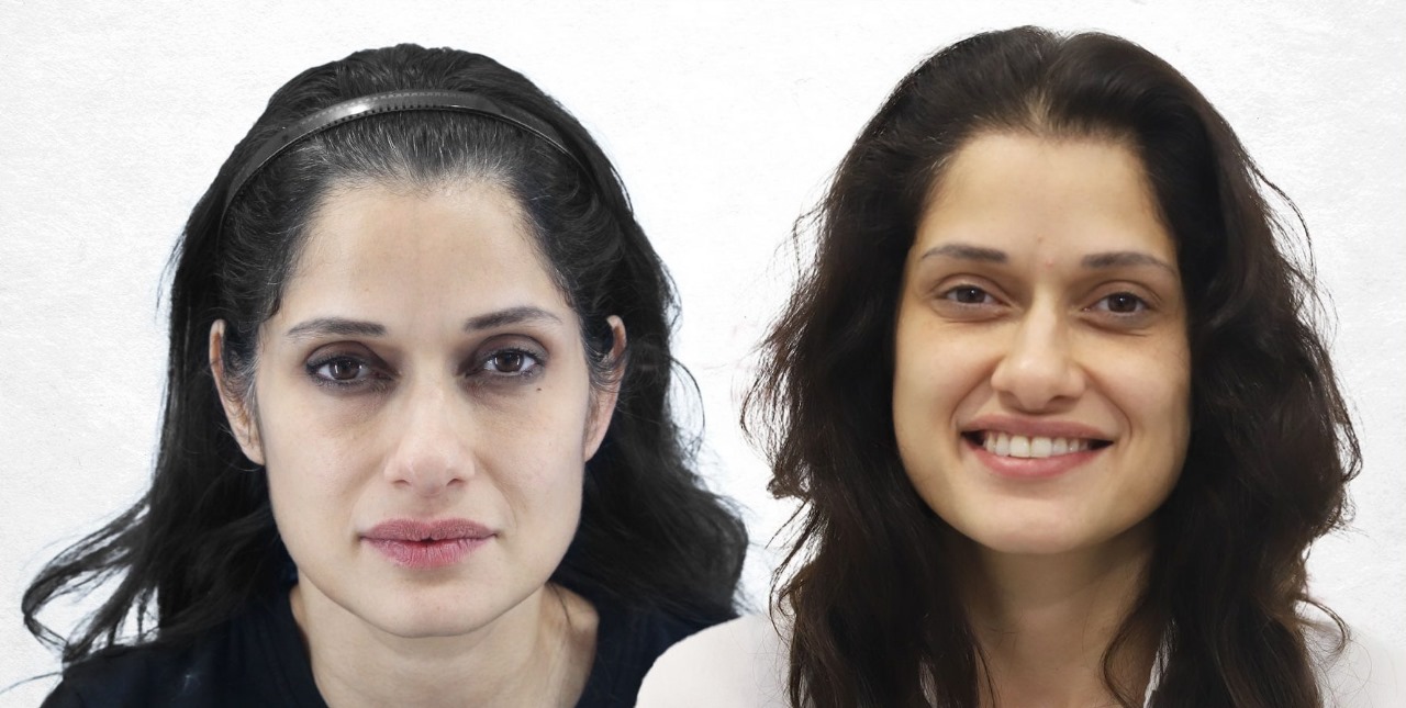 Hair Transplant UK: Expert Doctors, Beautiful Outcomes